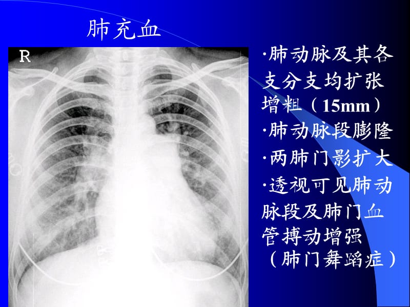 肺充血与肺淤血区别.ppt_第3页