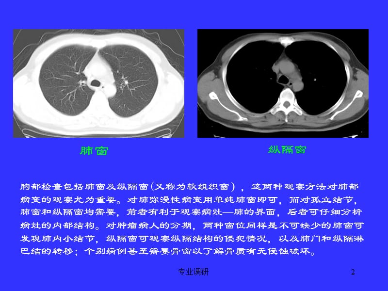 胸部CT诊断精讲班#严选材料.ppt_第2页