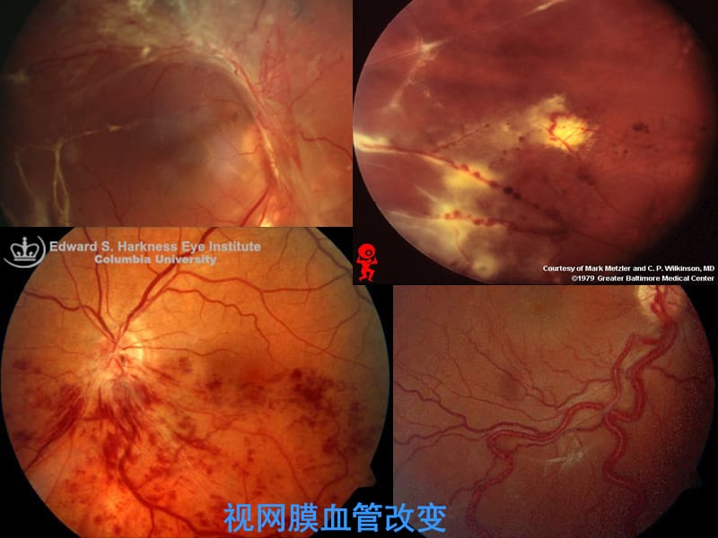 视网膜血管疾病.ppt_第3页