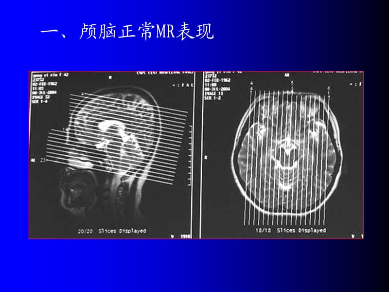 磁共振成像诊断 (MRI)脑部疾病.ppt_第3页