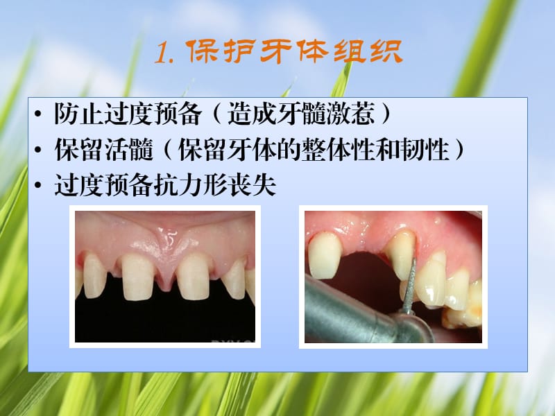牙体预备的基本要点.ppt_第3页