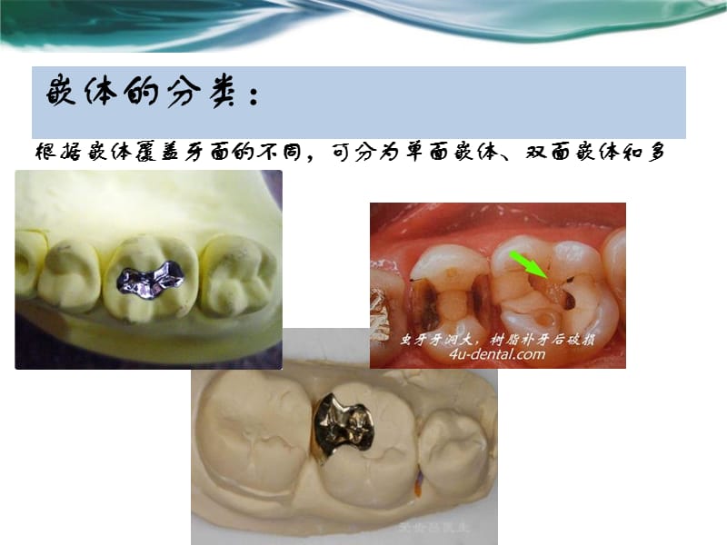 牙体缺损的嵌体修复.ppt_第3页