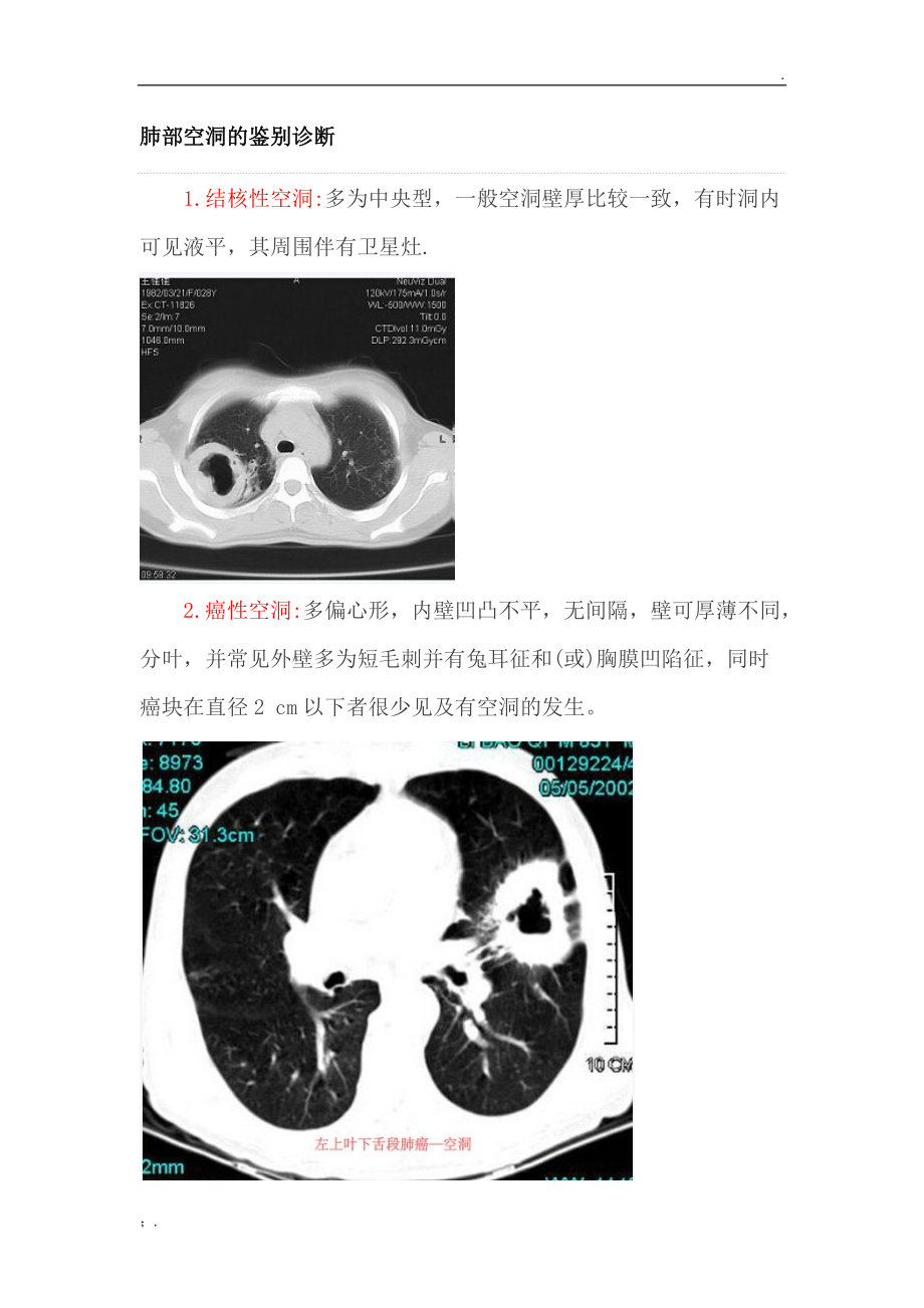 肺部空洞的鉴别诊断.docx_第1页