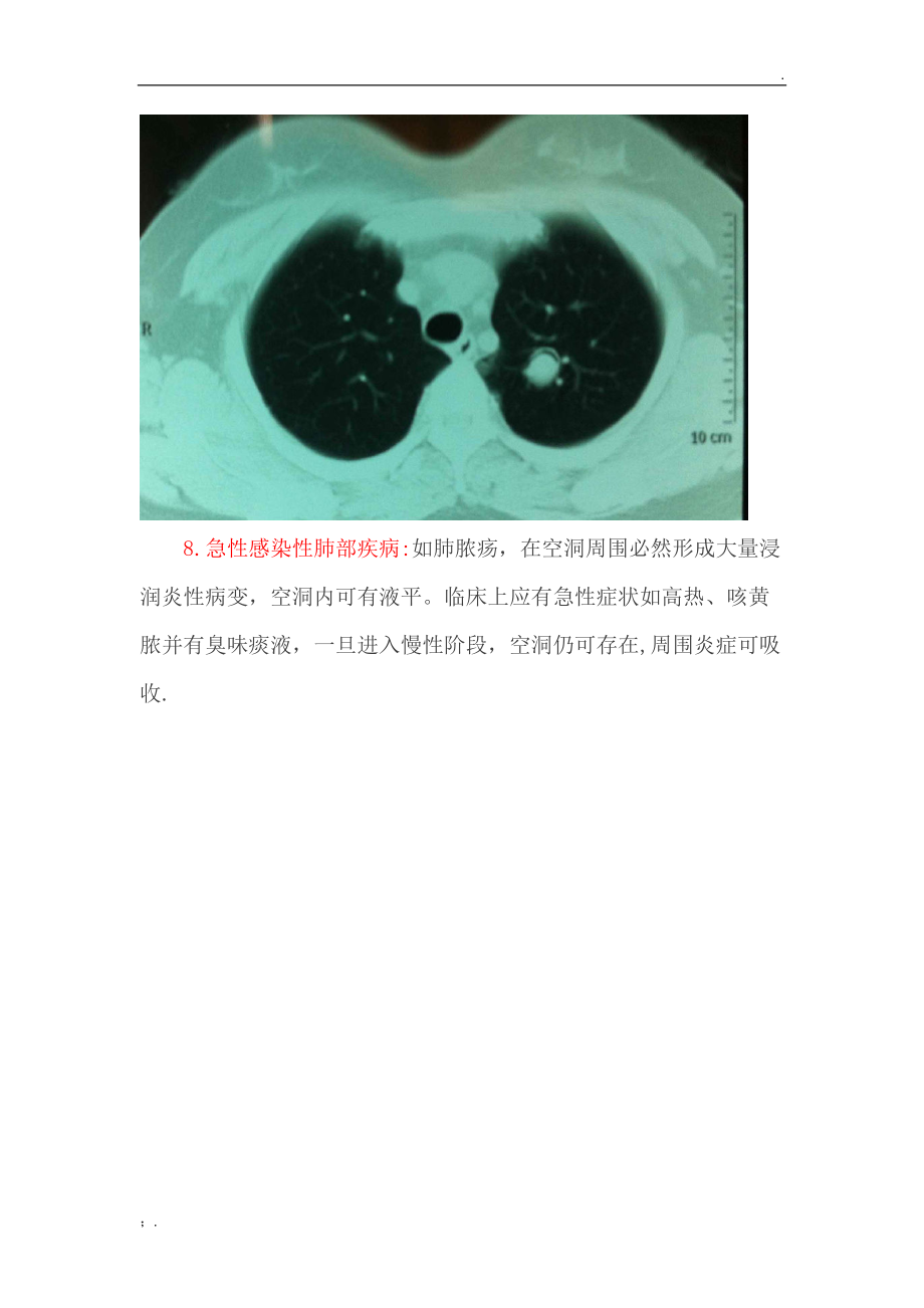肺部空洞的鉴别诊断.docx_第3页