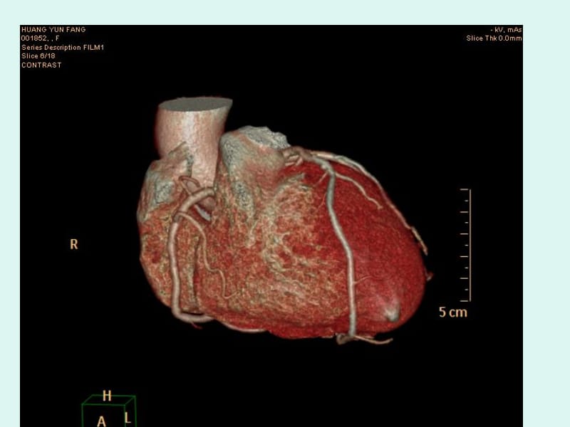 心脏冠状动脉CTA.ppt_第3页