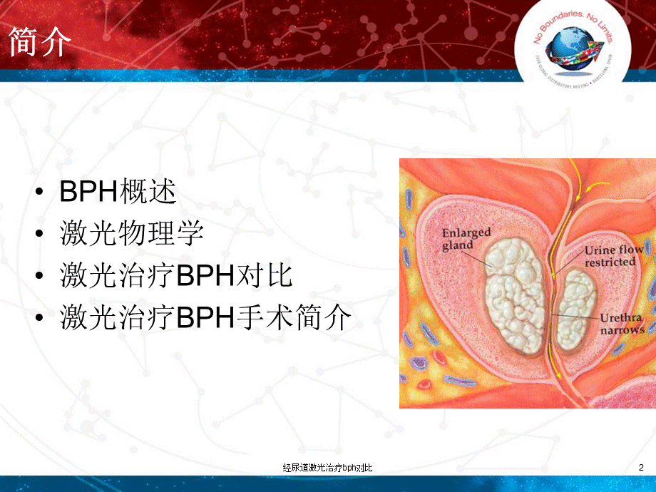 经尿道激光治疗bph对比课件.ppt_第2页