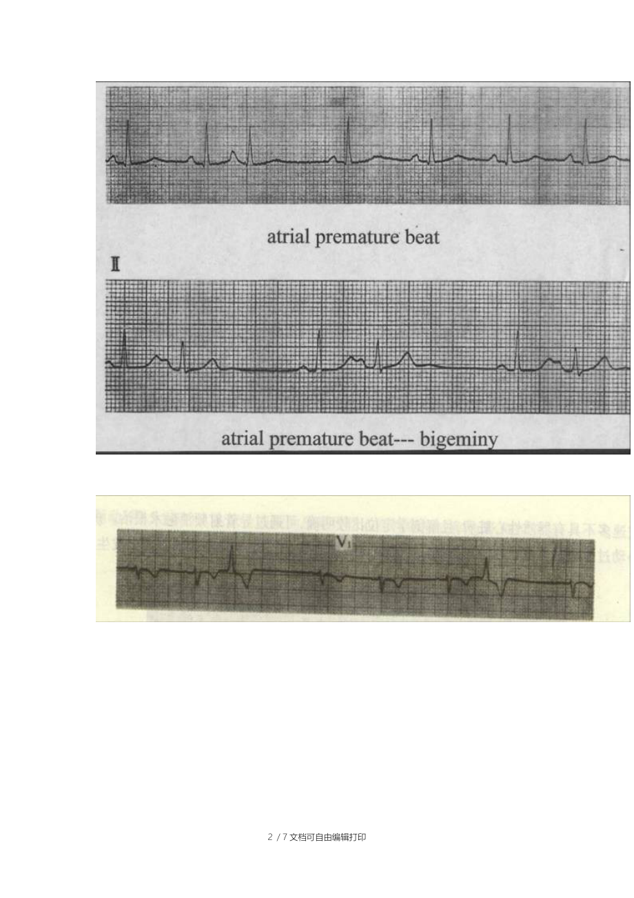 正常的心电图报告样式-简洁版.doc_第2页
