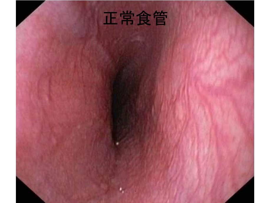正常胃镜图片及常见病变.ppt_第3页