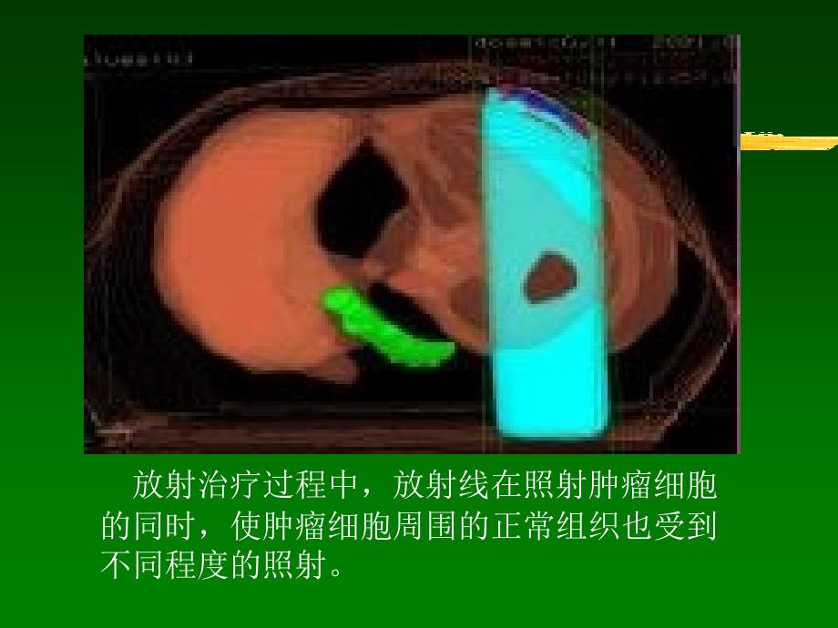 放射治疗技术PPT课件.ppt_第3页