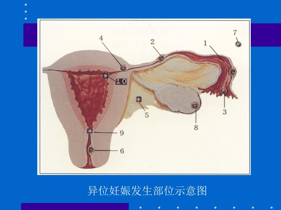异位妊娠的超声诊断.ppt_第3页