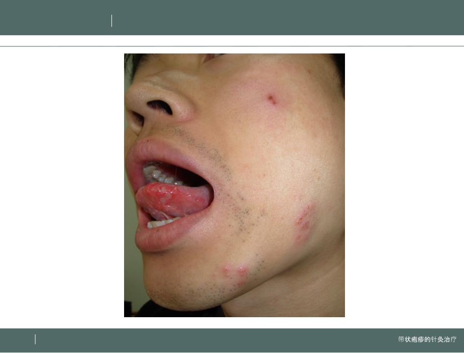 带状疱疹中医治疗PPT课件.ppt_第3页