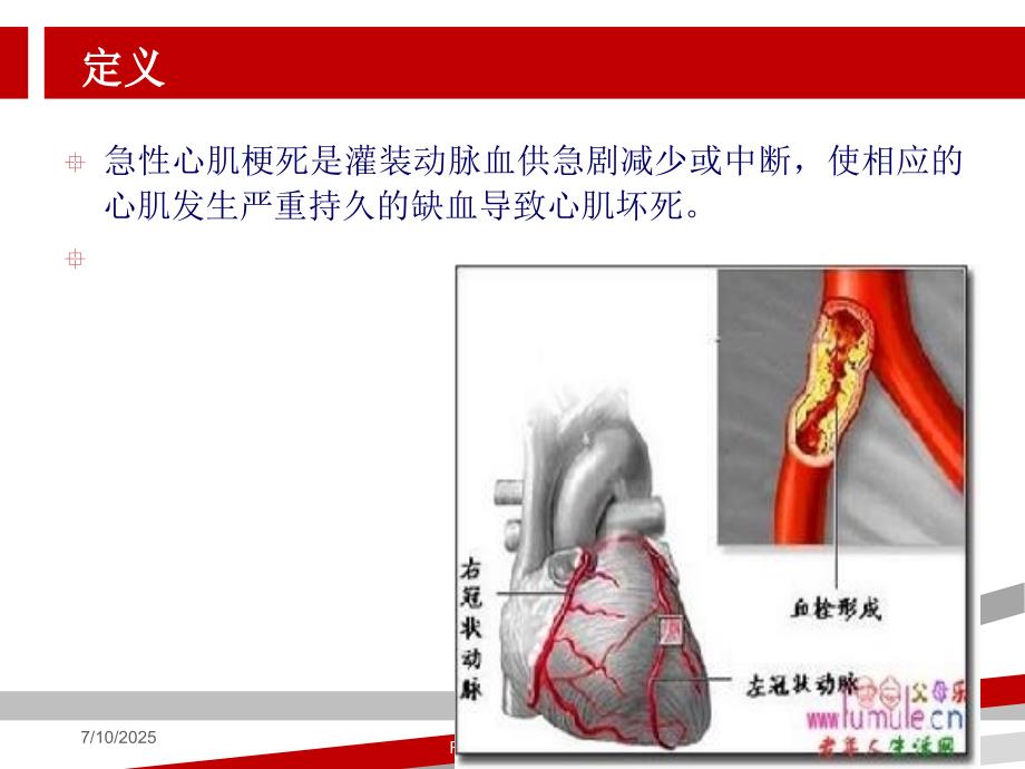 急性心肌梗死病人的护理.ppt课件.ppt_第3页