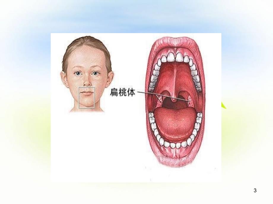 扁桃体手术配合PPT参考幻灯片.ppt_第3页