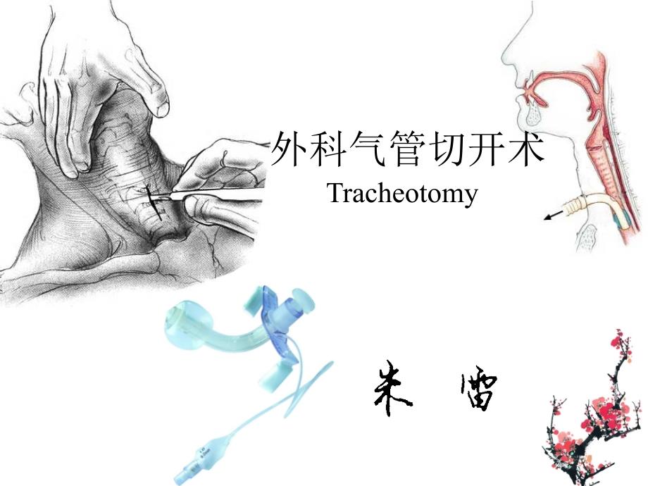 气管切开术Tracheotomy课件.ppt_第2页