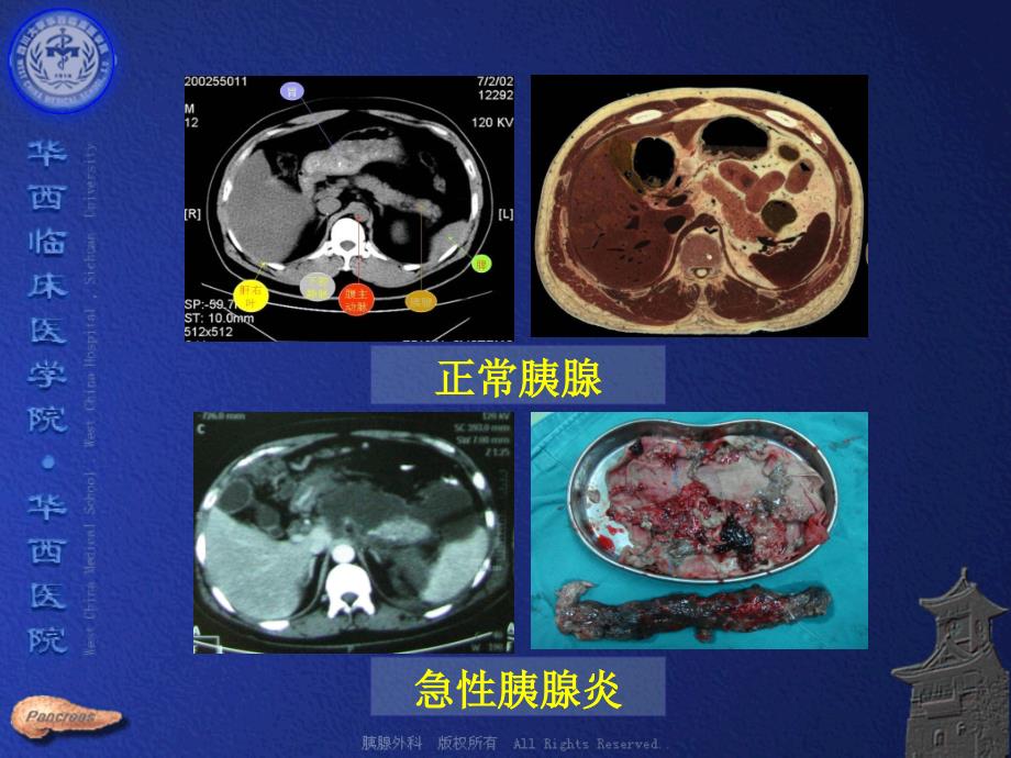 急性胰腺炎的外科治疗.ppt_第3页