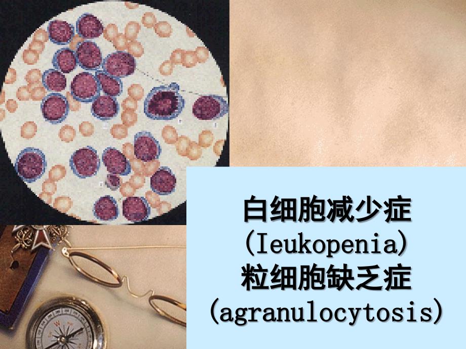 白细胞减少症PPT课件.ppt_第2页