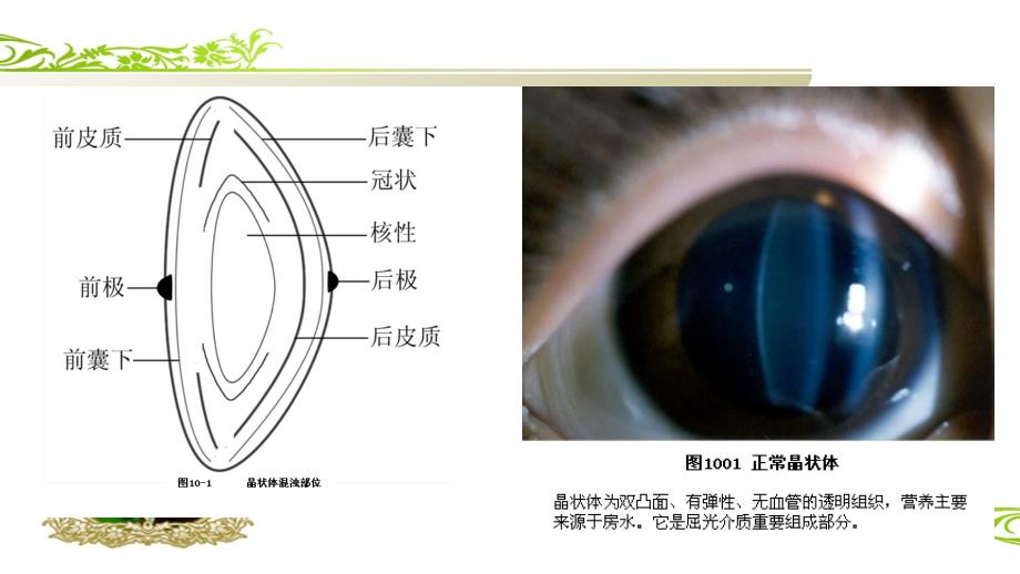 白内障ppt课件.pptx_第3页