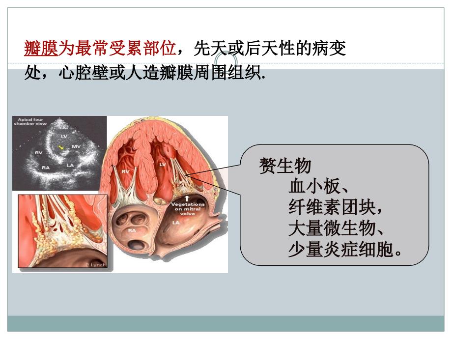感染性心内膜炎护理查房医学PPT.ppt_第3页