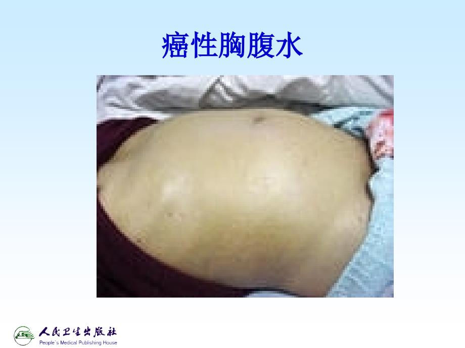 放射性核素介入治疗.ppt_第2页
