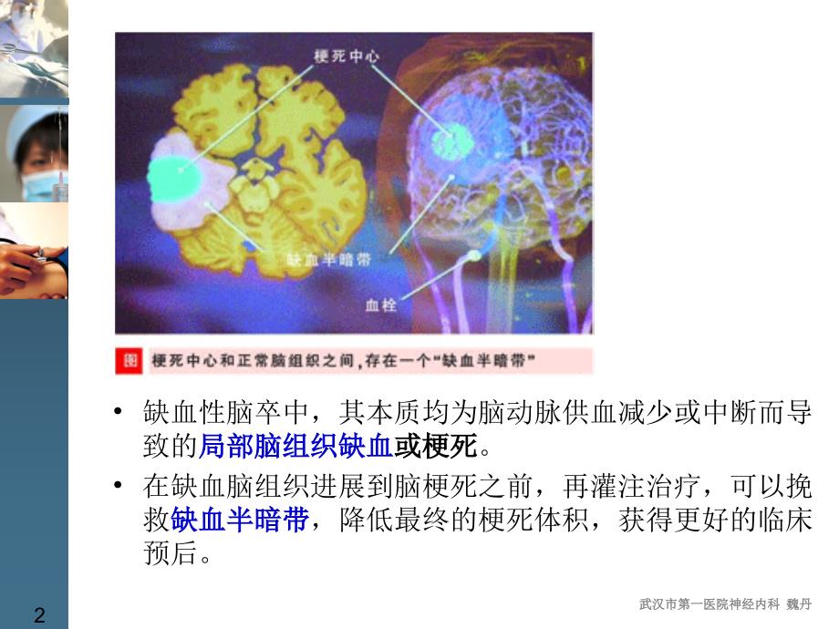 急性缺血性脑卒中取栓治疗技术.ppt_第2页