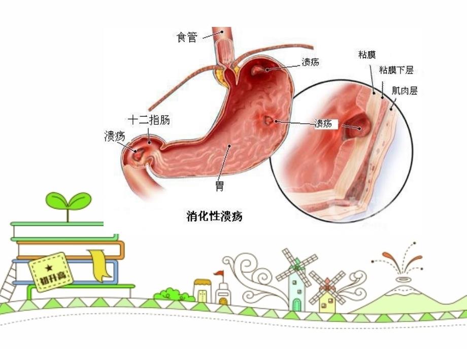 消化性溃疡的护理查房.ppt_第3页