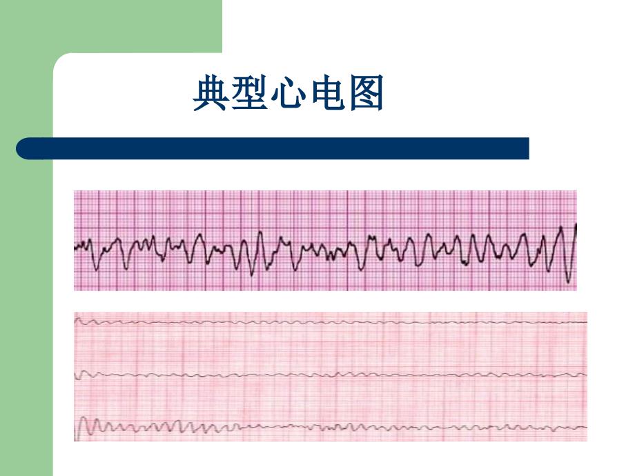 心脏电除颤后患者的护理李沛珍.ppt_第3页