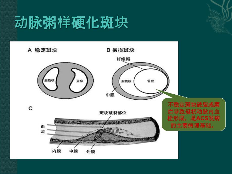 急性冠脉综合症的病理生理.ppt_第3页