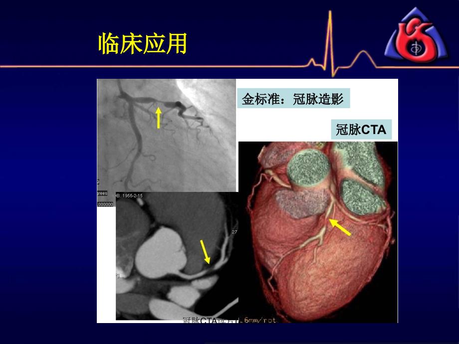 最新冠脉CTA读片非常经典.ppt_第2页