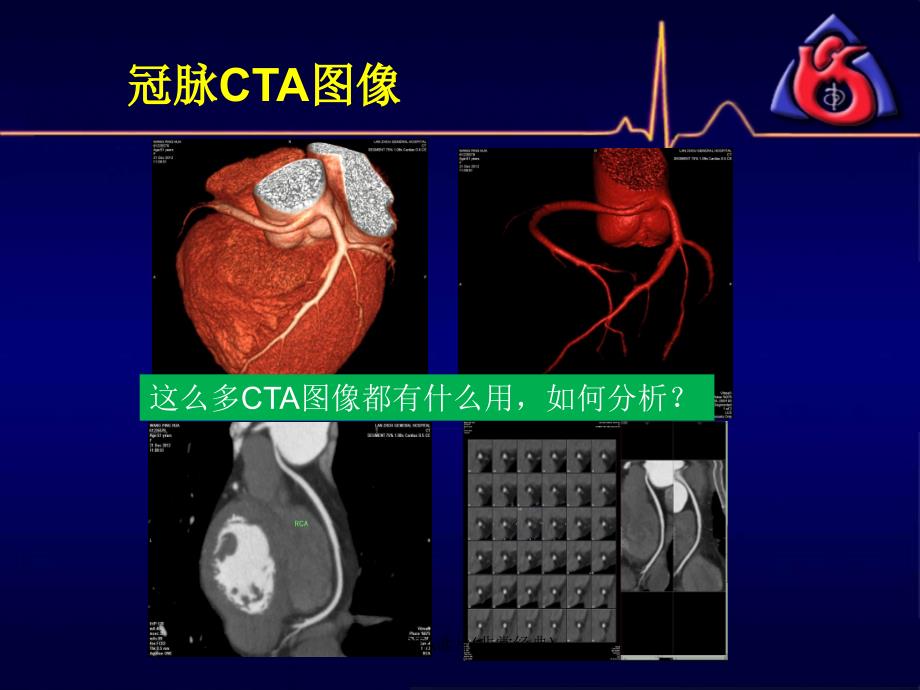 最新冠脉CTA读片非常经典.ppt_第3页