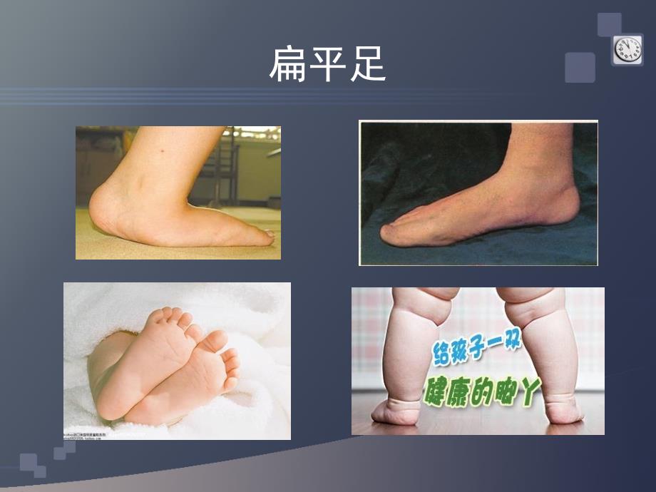 扁平足的防治PPT课件.ppt_第2页