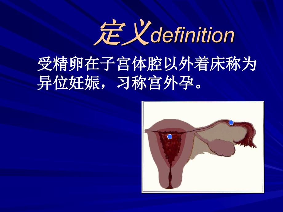 异位妊娠PPT课件.ppt_第2页