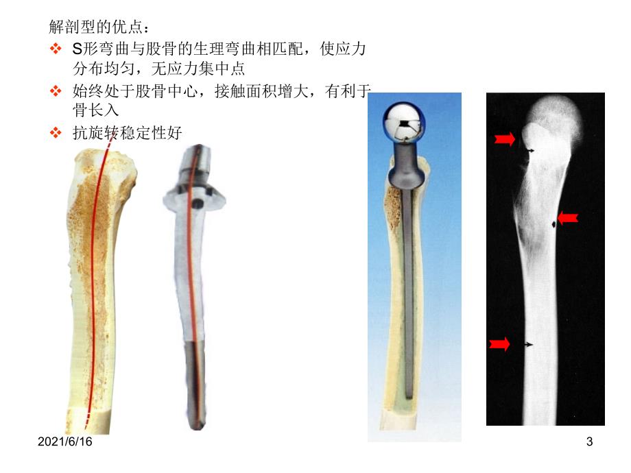 常用髋关节假体.ppt_第3页