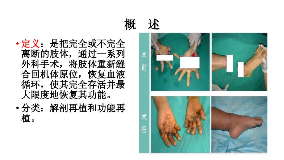 断肢指再植病人的护理.pptx_第2页