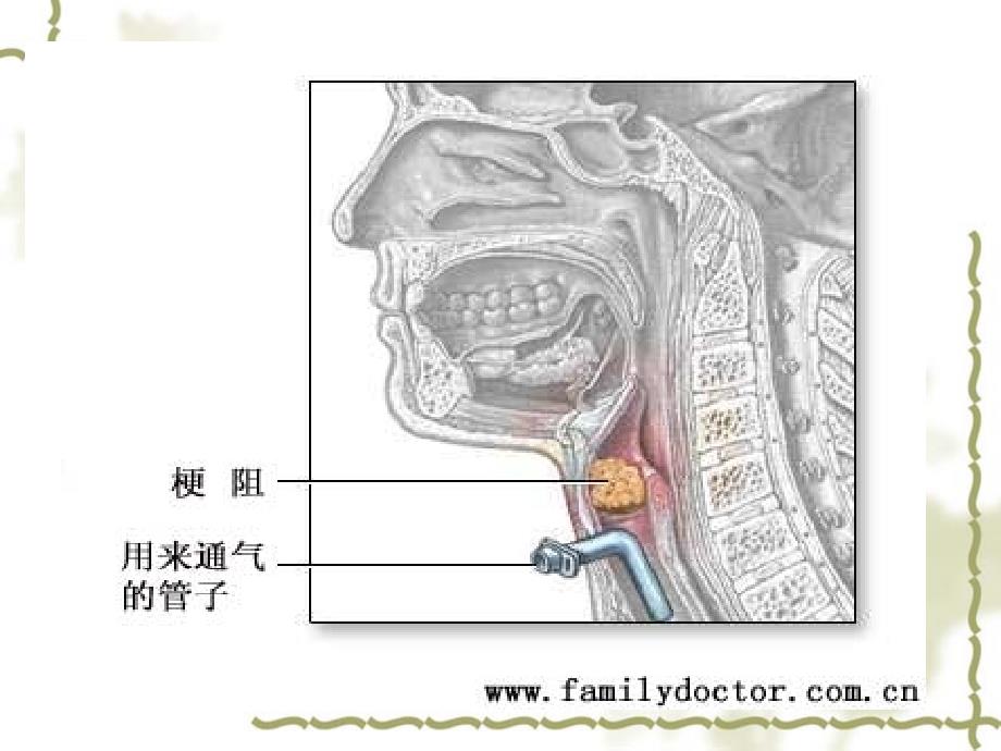 急性喉梗阻的护理课件.ppt_第3页