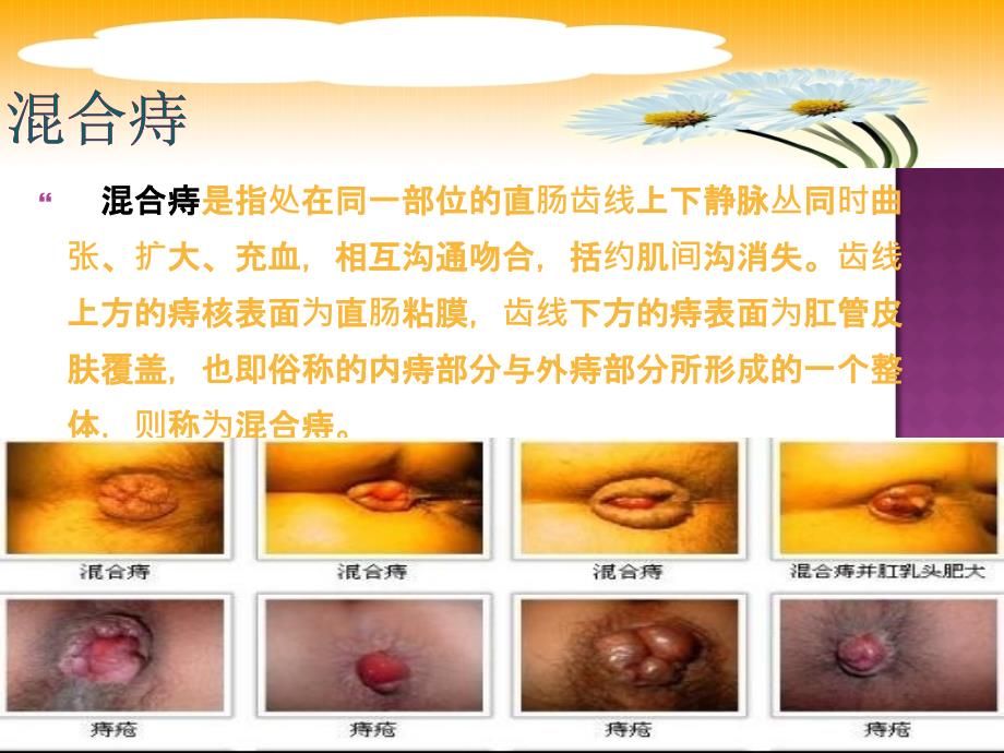 混合痔护理查房.ppt_第3页