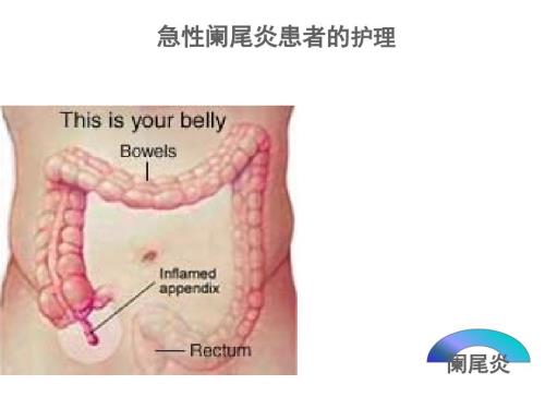 急性阑尾炎患者的护理PPT课件.ppt