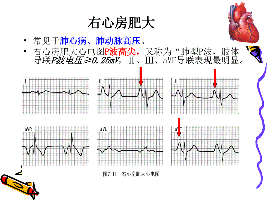 常见异常心电图PPT课件.ppt_第3页