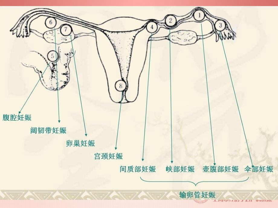 异位妊娠护理查房.ppt_第3页