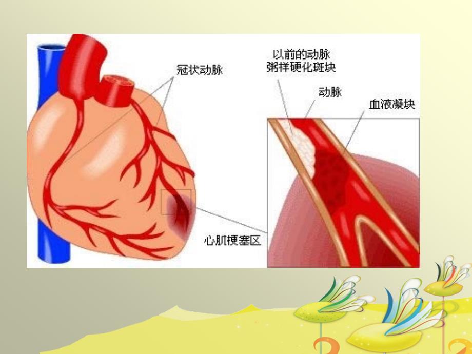 心肌梗死健康教育.ppt_第3页