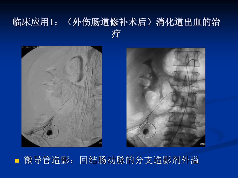 急性动脉性出血的介入治疗.ppt_第2页