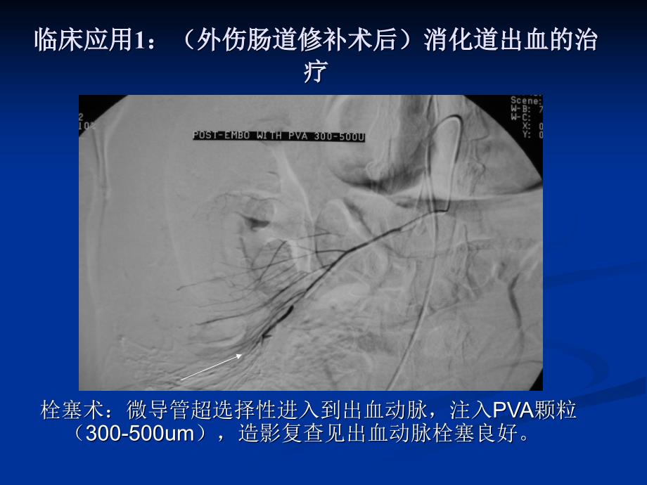 急性动脉性出血的介入治疗.ppt_第3页
