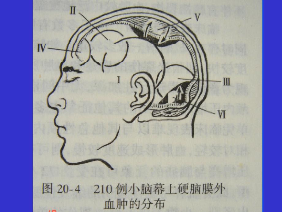 急性硬膜外血肿PPT课件.ppt_第3页