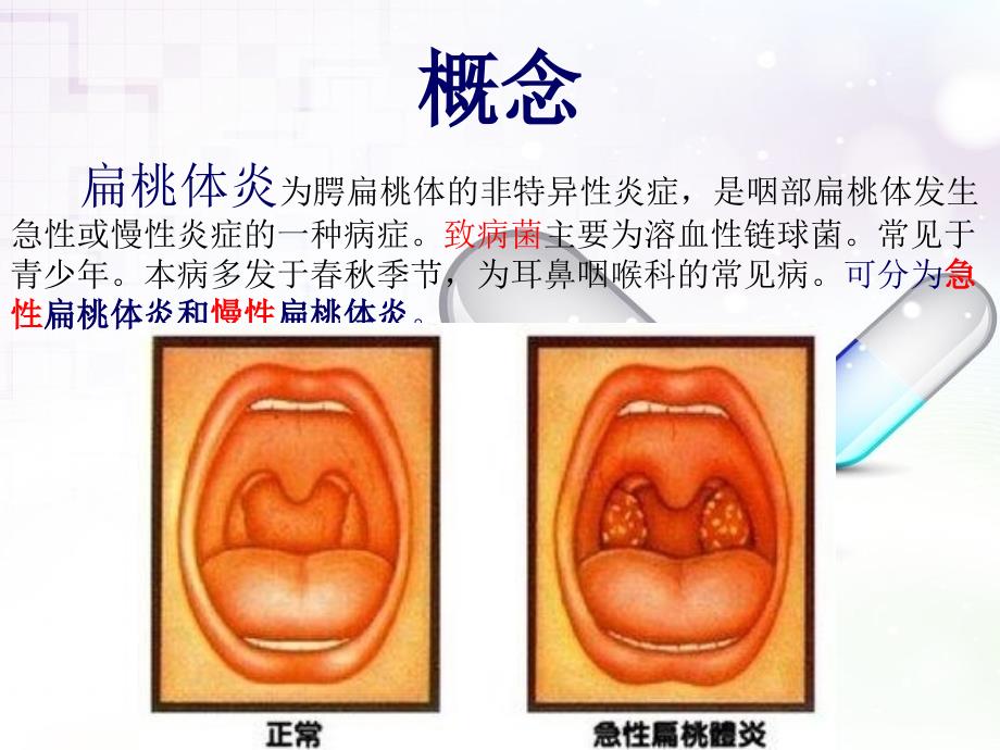 护理查房慢性扁桃体炎.pptx_第2页