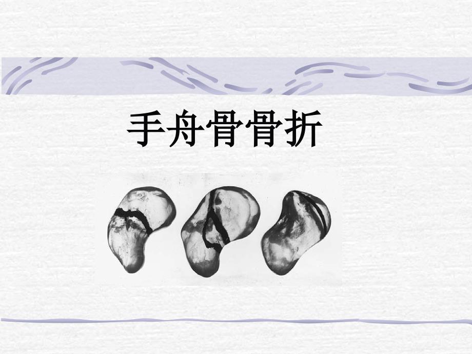 手舟骨骨折PPT课件.ppt_第1页