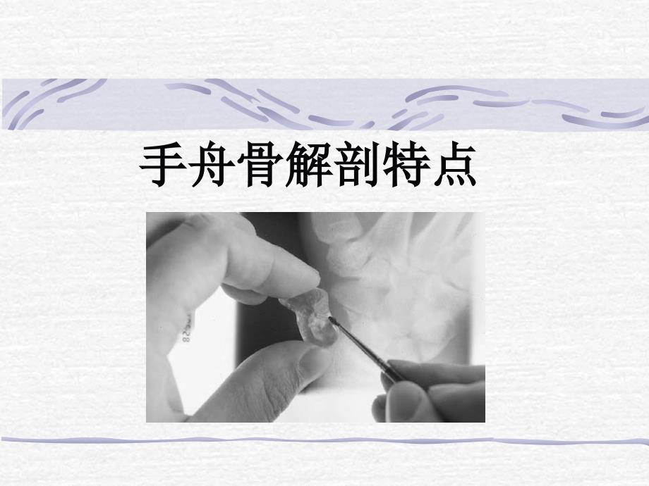 手舟骨骨折PPT课件.ppt_第2页