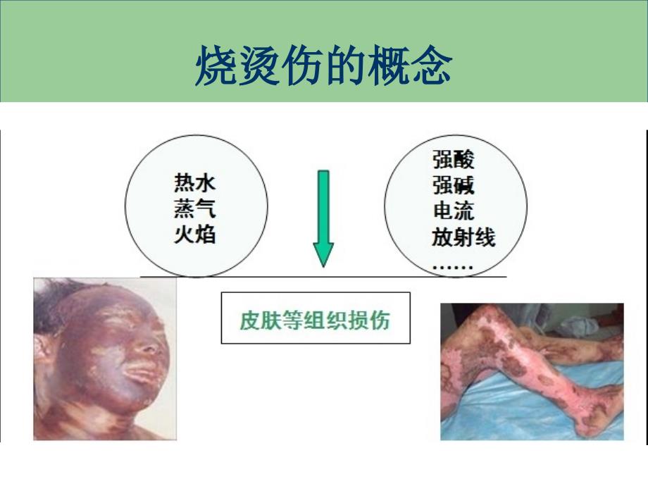 烧烫伤急救处理PPT课件.ppt_第2页