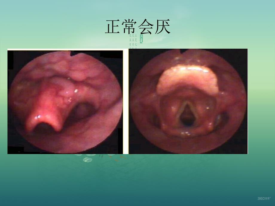 急性会厌炎的护理.ppt_第3页
