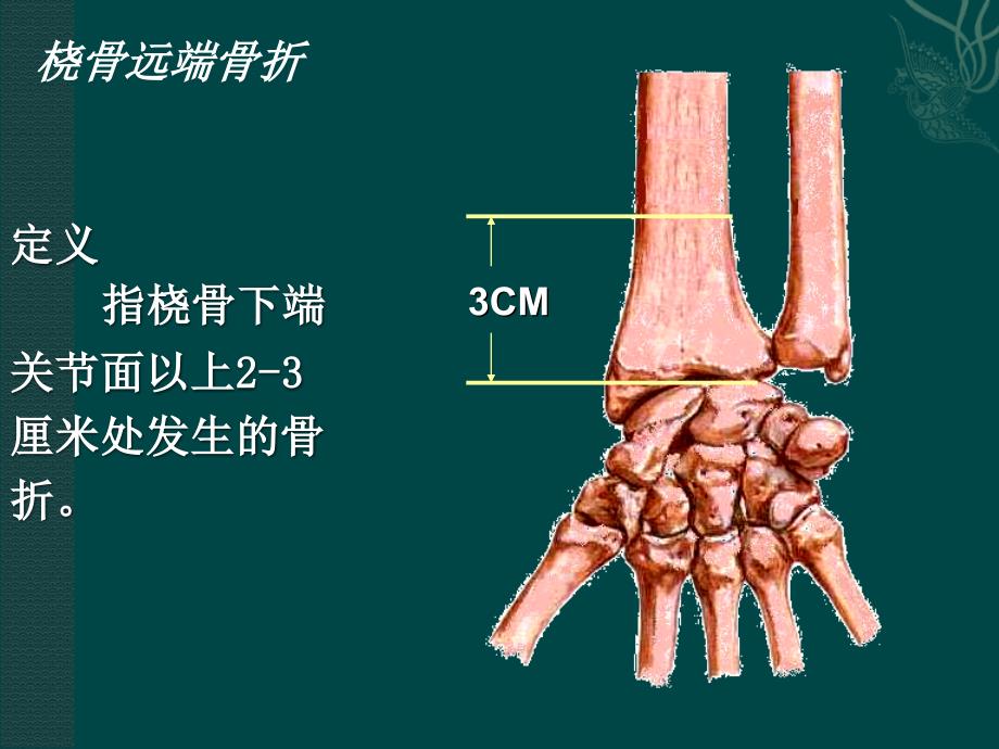 桡骨远端骨折课件.ppt_第2页