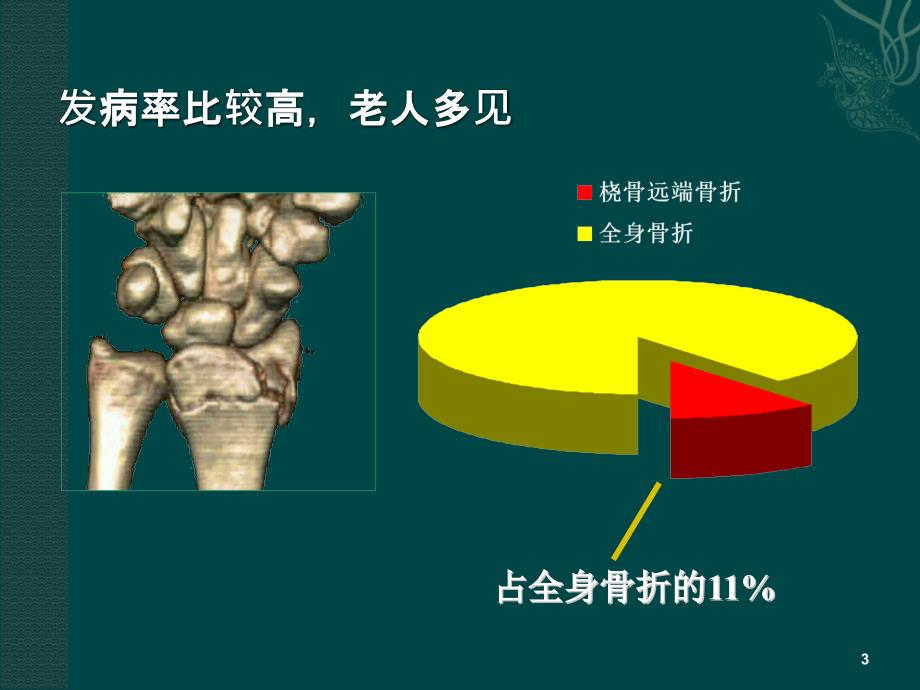 桡骨远端骨折课件.ppt_第3页