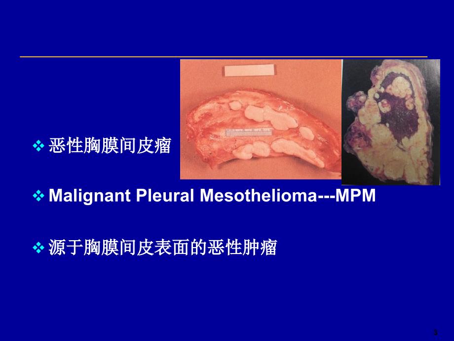 恶性胸膜间皮瘤PPT课件.ppt_第3页